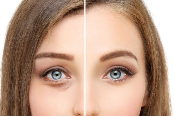 blefaroplastia inferior en valencia