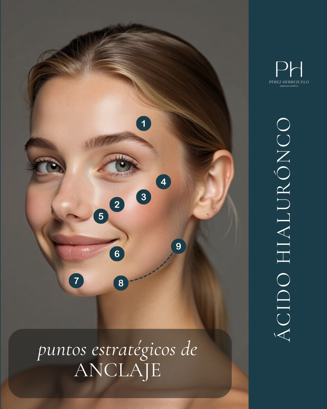 puntos de anclaje con ácido hialurónico